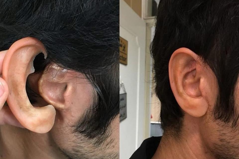Before-and-after results of an Orthowalk silicone prosthesis